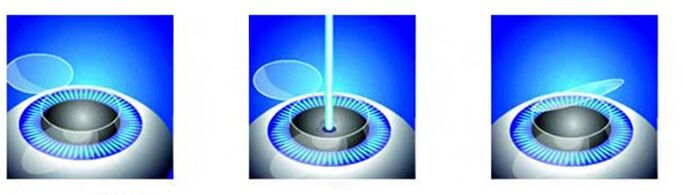 Fasi della correzione della visione laser
