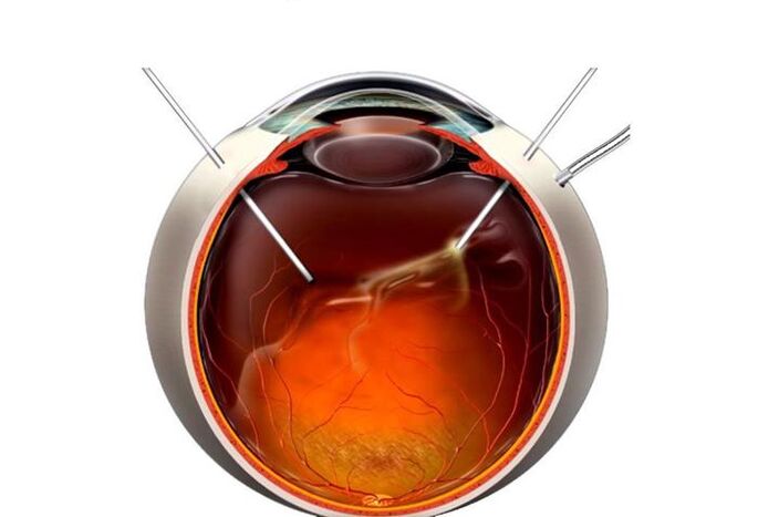 Vitrectomia intervento chirurgico per ripristinare la vista